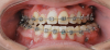 Fig 7. An asymmetric class III patient decompensated through the use of TADs in both arches. Fig 6: A previous compensatory treatment from another orthodontist. Fig 7: Case was decompensated with the use of TADs. Note occlusal plane correction and teeth that are now upright over their basal bone in preparation for orthognathic surgery, producing a full left posterior crossbite as a consequence of decompensation.