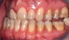 Fig 10. A class III adult male patient required surgical orthodontic treatment. The patient had anterior and posterior crossbites and required leveling of a deep curve of Spee during presurgical orthodontics.