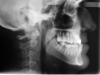 Fig 11. Pretreatment lateral (Fig 11) and posteroanterior (Fig 12) cephalometric x-rays, along with a lateral overjet image (Fig 13). Maxillary deficiency was present in the transverse and sagittal planes.