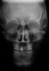 Fig 12. Pretreatment lateral (Fig 11) and posteroanterior (Fig 12) cephalometric x-rays, along with a lateral overjet image (Fig 13). Maxillary deficiency was present in the transverse and sagittal planes.