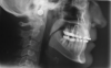 Fig 15. Postsurgical lateral (Fig 15) and posteroanterior (Fig 16) cephalometric x-rays, along with a panoramic x-ray (Fig 17). On the lateral cephalometric and panoramic x-rays, a robust .045-in transpalatal arch can be seen, which was used postsurgically to maintain the transverse correction achieved from the two-piece Le Fort 1 procedure.