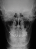 Fig 16. Postsurgical lateral (Fig 15) and posteroanterior (Fig 16) cephalometric x-rays, along with a panoramic x-ray (Fig 17). On the lateral cephalometric and panoramic x-rays, a robust .045-in transpalatal arch can be seen, which was used postsurgically to maintain the transverse correction achieved from the two-piece Le Fort 1 procedure.