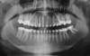 Fig 17. Postsurgical lateral (Fig 15) and posteroanterior (Fig 16) cephalometric x-rays, along with a panoramic x-ray (Fig 17). On the lateral cephalometric and panoramic x-rays, a robust .045-in transpalatal arch can be seen, which was used postsurgically to maintain the transverse correction achieved from the two-piece Le Fort 1 procedure.