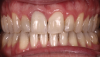 Fig 19. Bite interdigitation to finalize surgical orthodontic correction. After orthodontics, periodontal plastic surgery, bleaching, microabrasion, and restorative dentistry were performed.