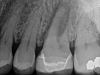 Fig 3. This penicillin-allergic patient presented with facial swelling secondary to pulpal necrosis with acute apical abscess on tooth No. 14 (Fig 2 and Fig 3). The swelling was consistent with cellulitis, thus systemic antibiotics were indicated in addition to definitive treatment by nonsurgical root canal therapy (Fig 4). Prior to 2019, clindamycin would have been the drug of choice, but newer guidelines warranted first-line use of cephalexin instead.10 Treatment in this case was initiated concurrently with antibiotic prescription and completed over two visits with the use of interappointment, intracanal calcium hydroxide. The infection resolved after treatment without complication.