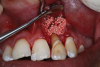 Fig 9. Clinical application of i-PRF: sticky bone for apical defect fill.