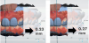 Fig 4. Data comparison software available today allows precise cross-sectional measurements of differences between scans taken over time.