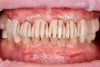 Fig 10. Performing depth cuts through the applied mockup allows controlled reduction of tooth structure.