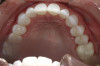 Fig 2. Patient presented with upper and lower anterior tooth crowding
of less than 3 mm. Figure 1: Anterior view. Figure 2: Upper arch. Figure 3: Lower
arch.