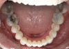 Fig 3. Patient presented with upper and lower anterior tooth crowding
of less than 3 mm. Figure 1: Anterior view. Figure 2: Upper arch. Figure 3: Lower
arch.