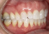 Fig 5. Right side buccal view (Figure 5) and left side buccal view (Figure 6) demonstrating class I bite with gingival abfraction.