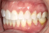 Fig 6. Right side buccal view (Figure 5) and left side buccal view (Figure 6) demonstrating class I bite with gingival abfraction.