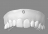 Fig 7. Digital scan of upper anterior
teeth.