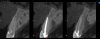 Fig 4. Preoperative CBCT cross-sectional view demonstrating very thin buccal cone.