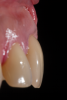 Fig 5. Preoperative clinical image of tooth No. 8 (1:1). A thin scalloped phenotype, prone to collapse upon removal of the tooth, was evident.