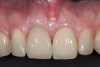 Fig 9. Facial view of clinical appearance of facial tissues at 1-year postoperative follow-up.