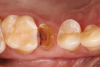 Fig 1. Hopeless maxillary second premolar.