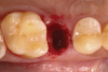 Fig 2. Minimally traumatic exodontia was performed to preserve the integrity of the socket walls and adjacent soft tissue.