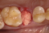 Fig 4. Absorbable bone scaffold material was adapted into the extraction socket and placed level with the soft-tissue height without condensation.