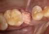 Fig 5. Absorbable bone scaffold material was sealed with fast-setting cyanoacrylate.