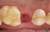 Fig 6. At 14 days, the protective cyanoacrylate seal had fallen out and adequate wound healing and a stable clot were observed. Soft-tissue granulation toward the center of the socket was evident.