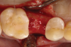 Fig 8. Upon full-thickness flap elevation, adequate alveolar ridge dimensions and optimal bone quality for implant placement were evident.