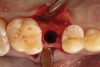 Fig 9. Adequate alveolar bone dimensions were observed, and optimal bone density and quality was confirmed during osteotomy preparation for implant placement.