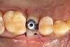 Fig 10. A healing cap was connected, and flaps were sutured with 4-0 absorbable sutures.