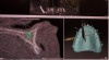 Fig 2. Digital planning software can be used to measure the amount of bone reduction that is required: Panorex view (top panel): anterior-posterior spread and right zygomatic implant. Left bottom panel: the thin knife-edged ridge and bicortical engagement of the nasal floor and amount of vertical bone reduction required. Right bottom panel: prosthetic screw axes after multi-unit correction.