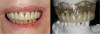 Fig 4. Double-scan technique. Denture preparation: the denture has gutta percha markers placed within it and scanning is performed with this denture in the patient’s mouth to generate the first set of DICOM files. A second scan of the denture itself in the CBCT scan (not shown) is used to generate the second DICOM set. Then both sets of DICOM files are superimposed in the implant planning software to superimpose the denture onto the 3D-rendered model.