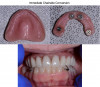 Fig 8. Chairside
conversion of the denture into a temporary prosthesis.
