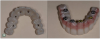 Fig 12. Screw axis of tooth No. 11 has been “hidden” into the distofacial line angle using the angulated screw channel.