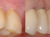 Fig 2. Recessions in ceramic (left) and titanium (right) implants.