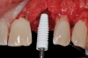 Fig 8. Insertion of metal-free ceramic implant (4.2 mm x 12 mm) 8 weeks after extraction of hopeless tooth No. 9.