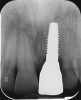 Fig 13. Radiograph after loading, showing solid bone remodeling within the machined implant neck area.