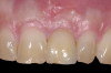 Fig 14. Restoration at 3-year follow-up, showing stable and good esthetic tissue outcome.