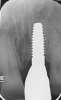 Fig 15. Radiograph at 3-year follow-up, showing stable bone situation compared to control radiograph after loading (Fig 13); note no bone loss.