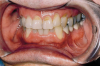 Fig 2. Photograph of a 75-year-old male patient of the author. This patient’s wife had reported him bruxing at night, which was seemingly related to the round-the-clock wear of a Nesbit appliance on the lower left region of tooth No. 20 that was replaced by a fixed bridge, Nos. 19 through 21. The wife reported a week later that her husband stopped nighttime bruxing behavior within a few days. This photograph was taken at a periodontal recall visit 2 years after placement of the lower left fixed bridge. There was still no evidence of direct or indirect bruxing behavior.