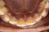Fig 3. A clinical example of severe chronic endogenous biocorrosion effects from anorexia nervosa. This patient was diagnosed and treated by a physician for this condition, which left lingual maxillary enamel almost free of this hard tissue. (Photograph is courtesy of Ali Tunkiwala, MDS, used with his permission.)