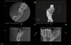 Fig 3. A 63-year-old male patient presented with a chief complaint of spontaneous pain and pressure discomfort of 3-week duration. A distal fracture line was visible on tooth No. 30, with a localized 7 mm deep periodontal probing depth adjacent to its distal aspect. The tooth had no response to pulp sensitivity testing and was sensitive to percussion. Periapical imaging (Fig 2) revealed a tooth with a shallow restoration and early signs of apical pathology. CBCT imaging (Fig 3, axial view, top left; and sagittal view, bottom right) confirmed early signs of apical pathology and showed localized crestal bone loss adjacent to the distal fracture line. A diagnosis of pulpal necrosis with symptomatic apical periodontitis was made, and the fracture was determined to involve root structure given the periodontal findings and radiographic crestal bone loss noted. The patient elected to pursue extraction with implant replacement given the reduced long-term prognosis for maintenance of the tooth.