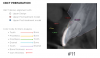 Fig 4. Crown lengthening plan for tooth No. 11.