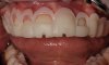 Fig 5. 3D-printed crown lengthening (CL) guide in situ.