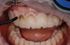 Fig 6. Gingivectomy stage of crown lengthening procedure with CL guide.