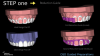 Fig 11. Incisal and buccal preparation reduction guides and plan.