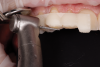 Fig 12. Initial incisal and buccal reduction of teeth with guides in situ.