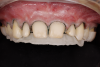 Fig 19. Verification of preparations with 3D-printed quality control guides in situ: front view (Fig 19), right lateral view (Fig 20), occlusal view (Fig 21).