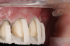 Fig 20. Verification of preparations with 3D-printed quality control guides in situ: front view (Fig 19), right lateral view (Fig 20), occlusal view (Fig 21).