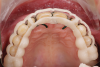 Fig 21. Verification of preparations with 3D-printed quality control guides in situ: front view (Fig 19), right lateral view (Fig 20), occlusal view (Fig 21).