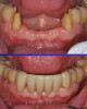 Fig 1. Monolithic high-strength zirconia bridge milled from a single zirconia disc (no layering). Zirconia in this form allows for the greatest strength, but esthetics can be compromised (although still clinically acceptable, as in the case shown here).