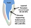 Fig 3. With layered zirconia restorations, the layering ceramic, along with the interface between the zirconia and layered ceramic, are weak links in the restorative assembly.